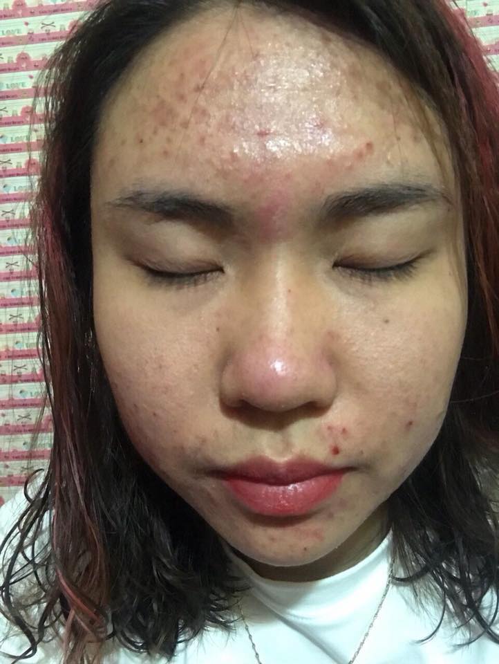 Hình ảnh da mặt nhờn bị mụn 